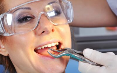 What is a Simple Dental Extraction?